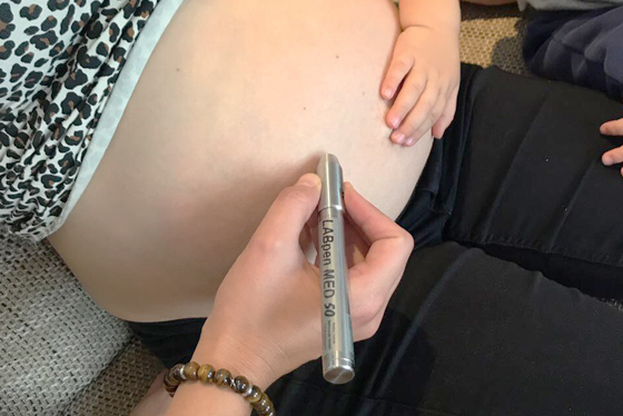 Softlaserbehandlung am Bauch